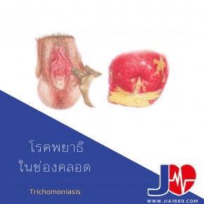 Trichomoniasis 