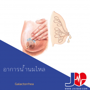 Galactorrhea 