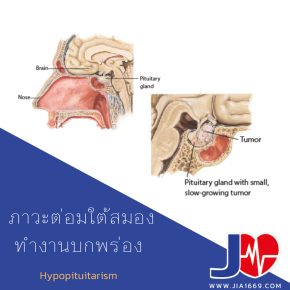 ภาวะต่อมใต้สมองทำงานบกพร่อง