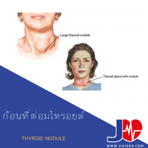 THYROID NODULE 