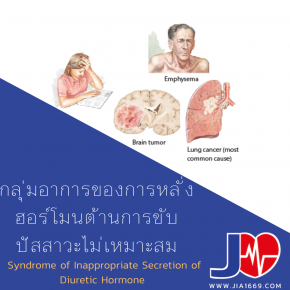 Syndrome of Inappropriate Secretion of Diuretic Hormone 