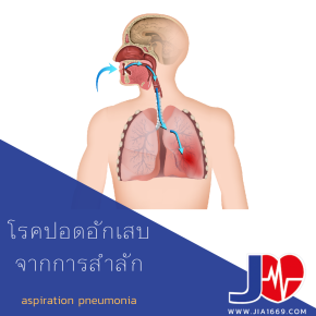 โรคปอดอักเสบจากการสำลัก