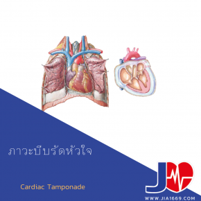  Cardiac Tamponade
