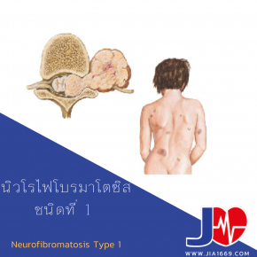  Neurofibromatosis Type 1