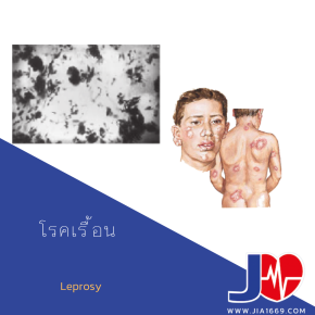 Leprosy