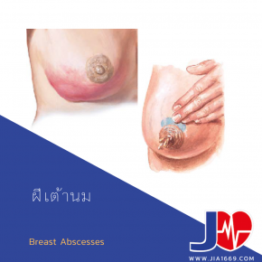 Breast Abscesses