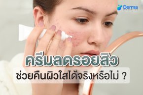 Acne, also known as acne vulgaris