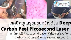 แนะนำเทคนิคดูแลรูขุมขนกว้าง: เทคนิคดูแลรูขุมขนกว้างด้วย Deep Carbon Peel Picosecond Laser (เทคนิคการใช้ Picosecond Laser พิโค่เลเซอร์ ร่วมกับผง carbon กระตุ้นการสร้างคอลลาเจนดูแลรูขุมขนกว้าง )