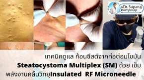แนะนำเทคนิคดูแล ก้อนซีสต์จากท่อต่อมไขมัน Steatocystoma Multiplex (SM) ด้วย เข็มพลังงานคลื่นวิทยุ Insulated Radiofrequency RF Microneedle for Steatocystoma Multiplex Treatment
