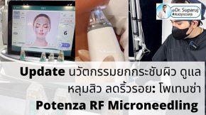 Update นวัตกรรมยกกระชับผิว ดูแลหลุมสิว ลดริ้วรอย: Potenza RF Microneedling โพเทนซ่า