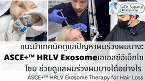 แนะนำเทคนิคดูแลปัญหาผมร่วงผมบาง: ASCE+™ HRLV Exosome เอเอสซีอีเอ็กโซโซม ช่วยดูแลผมร่วงผมบางได้อย่างไร? (ASCE+™ HRLV Exosome Therapy for Hair Loss)