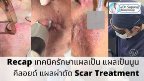 Recap เทคนิครักษาแผลเป็น แผลเป็นนูน คีลอยด์ แผลผ่าตัด Scar Treatment