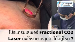 โปรแกรมเลเซอร์ Fractional CO2 Laser ยังใช้รักษาหลุมสิวได้อยู่ไหม ?