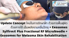 Update Concept ใหม่ในการรักษาฝ้า ด้วยการฟื้นฟูผิวด้วยการใช้ เข็มพลังงานคลื่นวิทยุ + Exosomes (SylfirmX Plus Fractional RF MicroNeedle + Exosomes for Melasma Skin Rehabilitation)