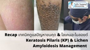  Recap เทคนิคดูแลปัญหาขนคุด & ไลเคนอะไมลอยด์ Keratosis Pilaris (KP) & Lichen Amyloidosis Management