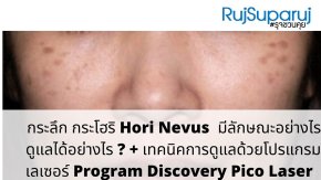 กระโฮริ ปานโฮริ Hori Nevus มีลักษณะ & ดูแลได้อย่างไร? + เทคนิครักษาด้วย โปรแกรม Discovery Pico Laserfor Hori Nevus Treatment