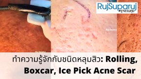 ทำความรู้จักชนิดหลุมสิว: Rolling, Boxcar และ Ice Pick Acne Scar