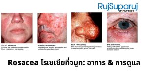 Rosacea โรเซเชียที่จมูก: อาการ & การดูแล