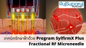 เทคนิครักษาฝ้าด้วย Program SylfirmX Plus Fractional RF Microneedle