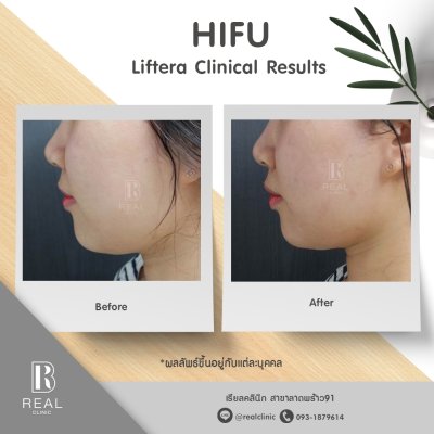 Real HIFU Liftera