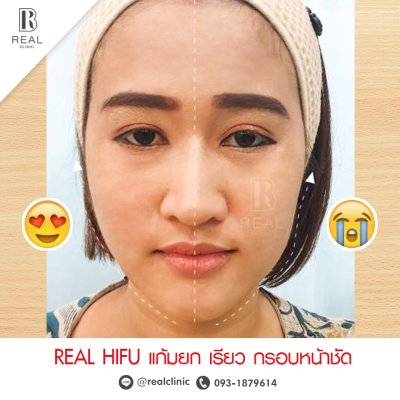 Real HIFU Liftera