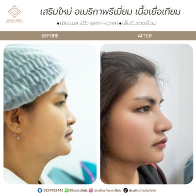 รีวิว เสริมจมูก (Rhinoplasty)