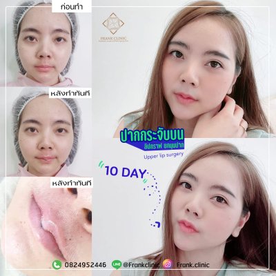 รีวิว ศัลยกรรม ปากกระจับ (Lip surgery)