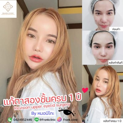 รีวิว ตาสองชั้น