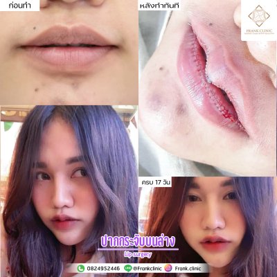 รีวิว ศัลยกรรม ปากกระจับ (Lip surgery)