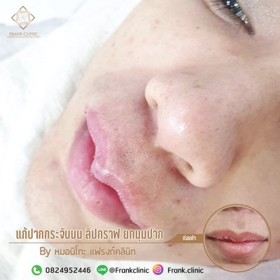 รีวิว ศัลยกรรม ปากกระจับ (Lip surgery)