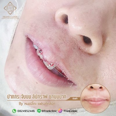 รีวิว ศัลยกรรม ปากกระจับ (Lip surgery)