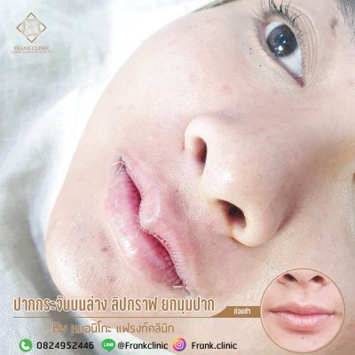 รีวิว ศัลยกรรม ปากกระจับ (Lip surgery)