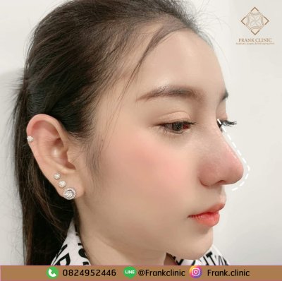 รีวิว เสริมจมูก (Rhinoplasty)