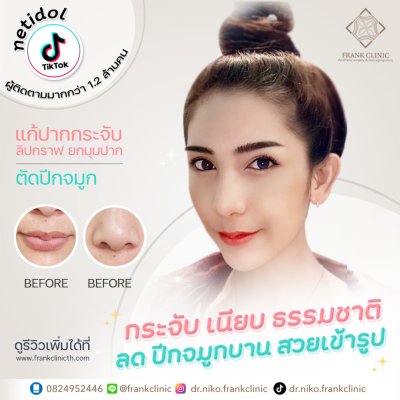 รีวิว ตัดปีกจมูก (Alarplasty)