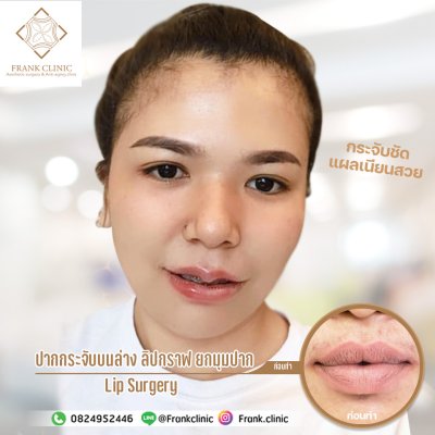 รีวิว ศัลยกรรม ปากกระจับ (Lip surgery)