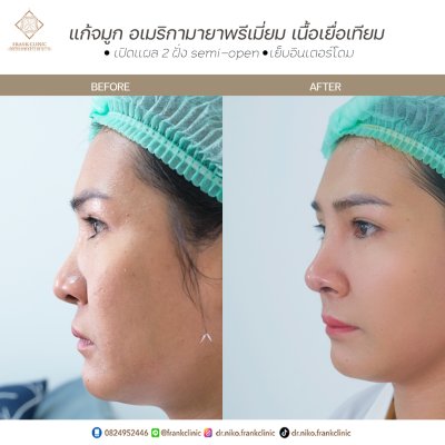 รีวิว เสริมจมูก (Rhinoplasty)