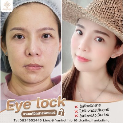 รีวิว เทคนิค EYELOCK ตัดถุงใต้ตา