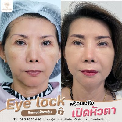 รีวิว เทคนิค EYELOCK ตัดถุงใต้ตา