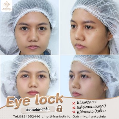 รีวิว เทคนิค EYELOCK ตัดถุงใต้ตา