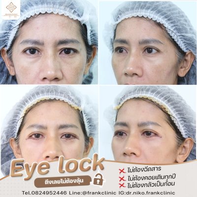 รีวิว เทคนิค EYELOCK ตัดถุงใต้ตา