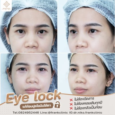 รีวิว เทคนิค EYELOCK ตัดถุงใต้ตา