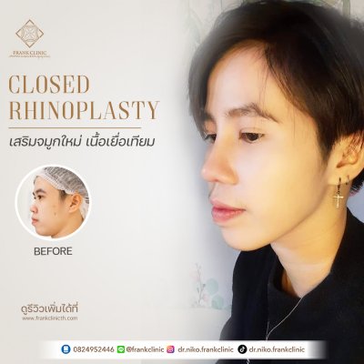 รีวิว เสริมจมูก (Rhinoplasty)