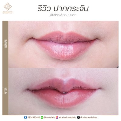 รีวิว ศัลยกรรม ปากกระจับ 2 (Lip surgery)