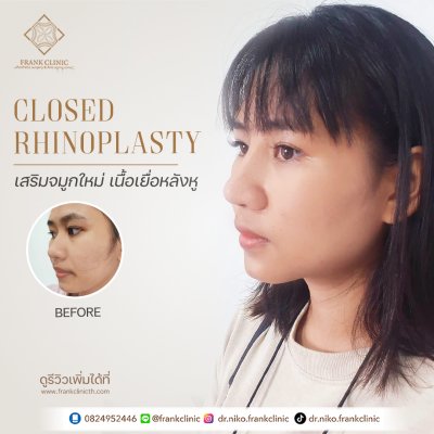 รีวิว เสริมจมูก (Rhinoplasty)