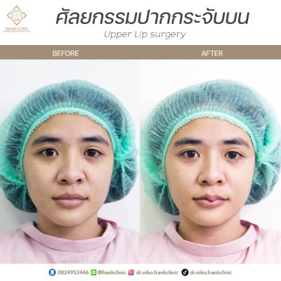 รีวิว ศัลยกรรม ปากกระจับ 2 (Lip surgery)