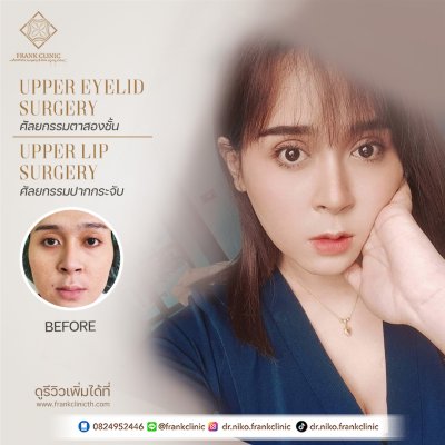 รีวิว ศัลยกรรม ปากกระจับ 2 (Lip surgery)