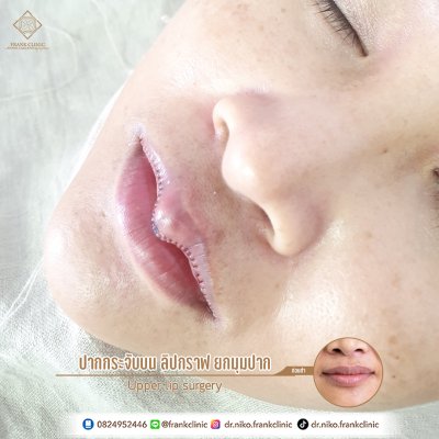 รีวิว ศัลยกรรม ปากกระจับ 2 (Lip surgery)