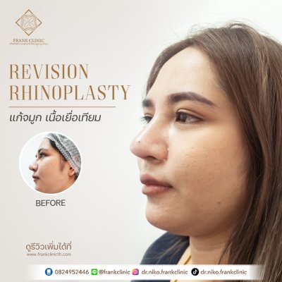 รีวิว เสริมจมูก (Rhinoplasty)