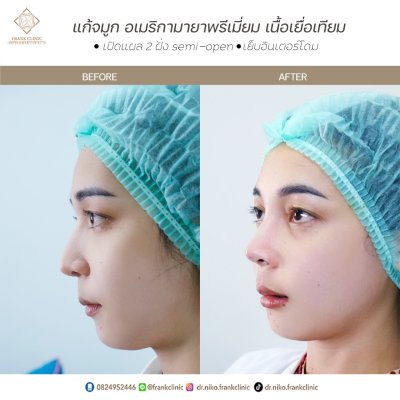 รีวิว เสริมจมูก (Rhinoplasty)