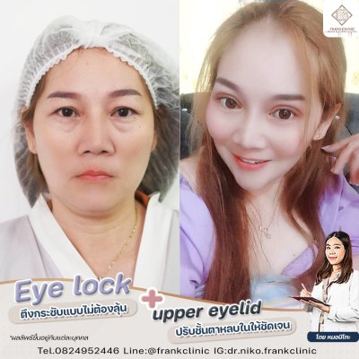 รีวิว เทคนิค EYELOCK ตัดถุงใต้ตา